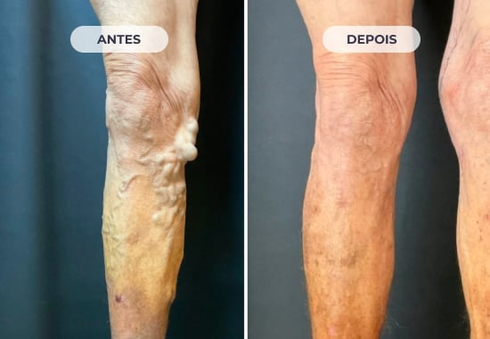 Comparação original do caso 1: perna antes e depois do tratamento de varizes.