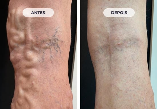 Comparação original do caso 2: detalhe da perna antes e depois do tratamento.