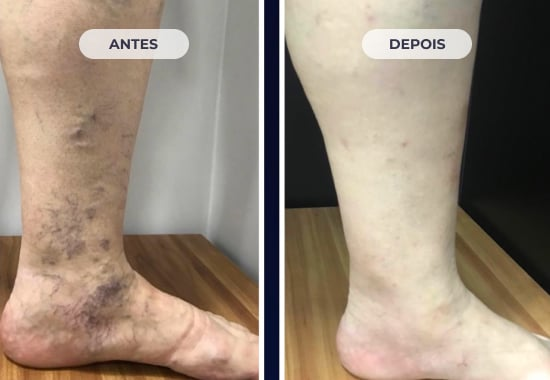 Comparação original do caso 3: região do tornozelo antes e depois do tratamento.